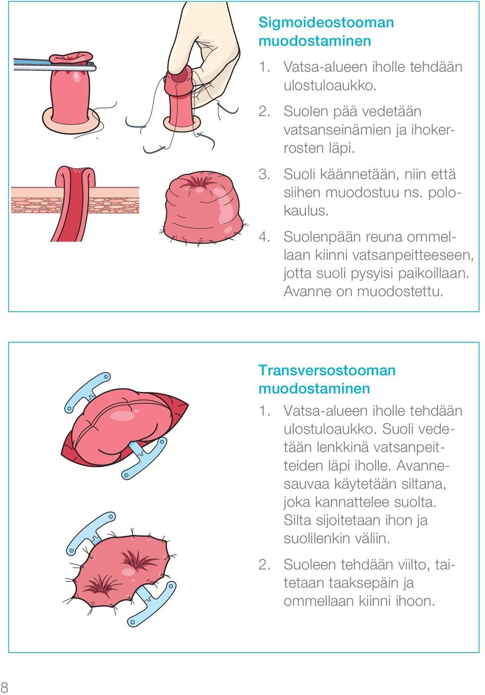 Avanne on muodostettu. Transversostooman muodostaminen 1. Vatsa-alueen iholle tehdään ulos tuloaukko. Suoli vedetään lenkkinä vatsanpeitteiden läpi iholle.