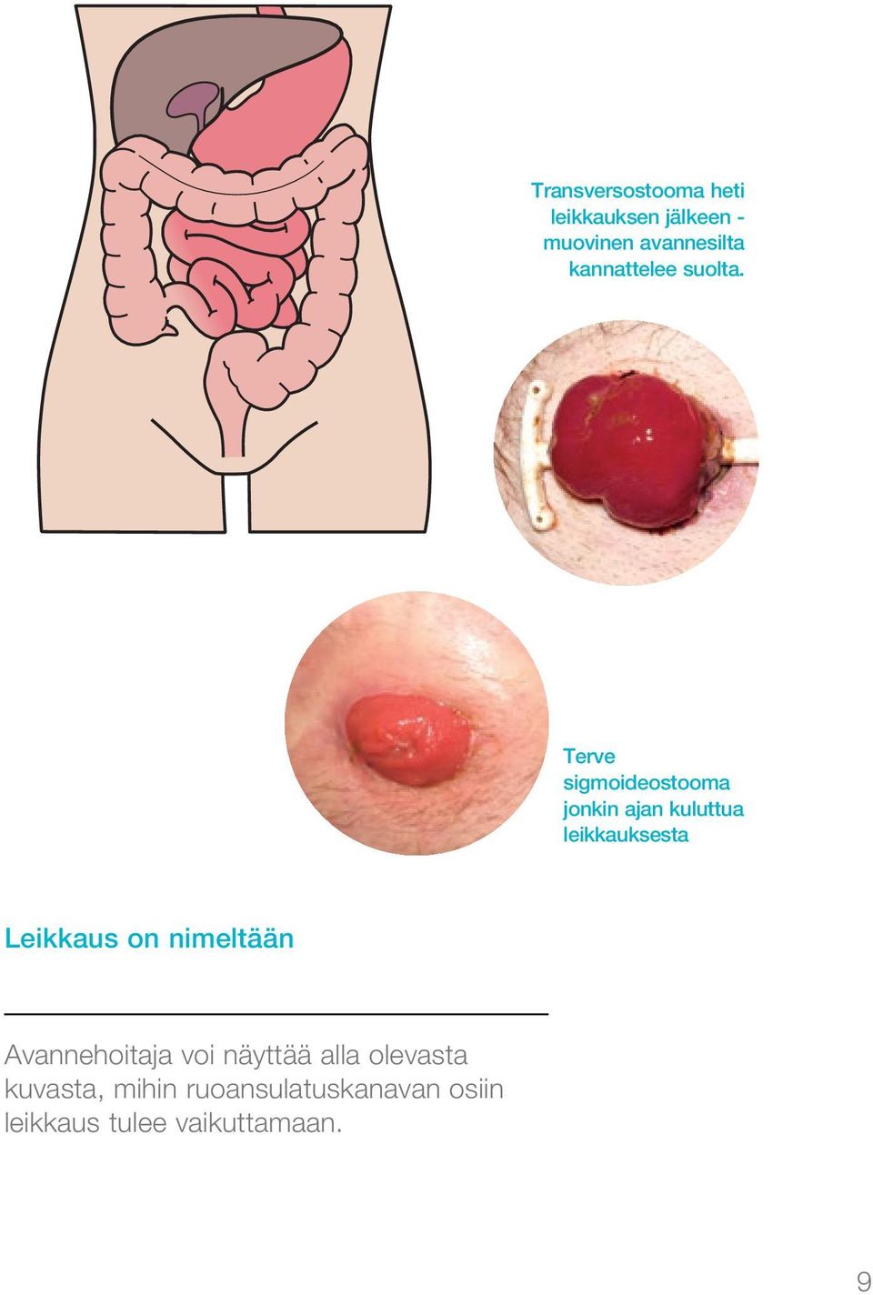 Terve sigmoideostooma jonkin ajan kuluttua leikkauksesta Leikkaus on