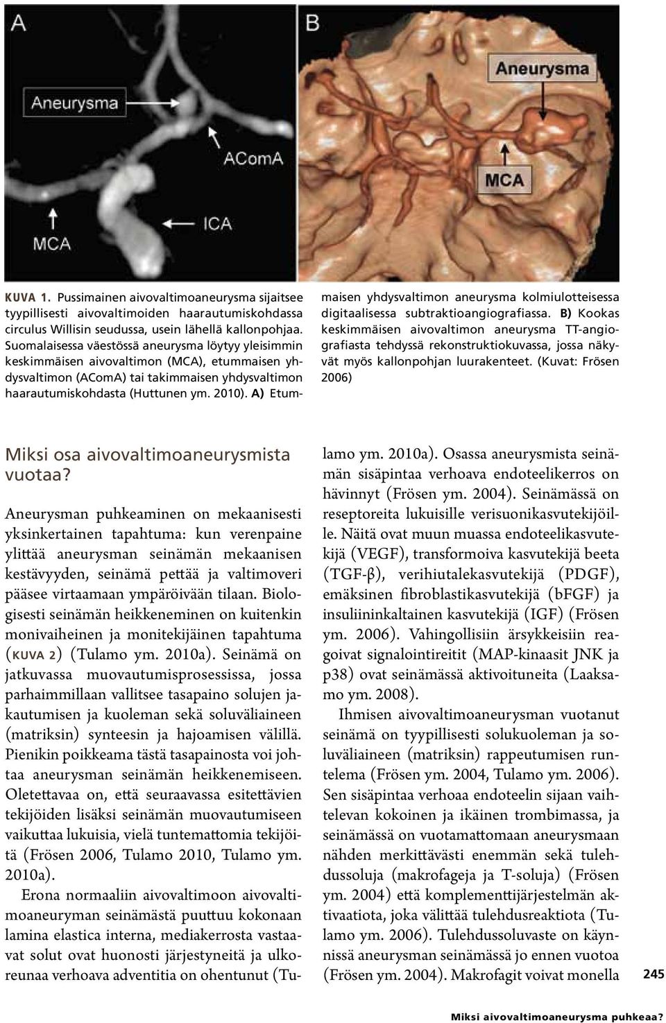 A) Etummaisen yhdysvaltimon aneurysma kolmiulotteisessa digitaalisessa subtraktioangiografias sa.