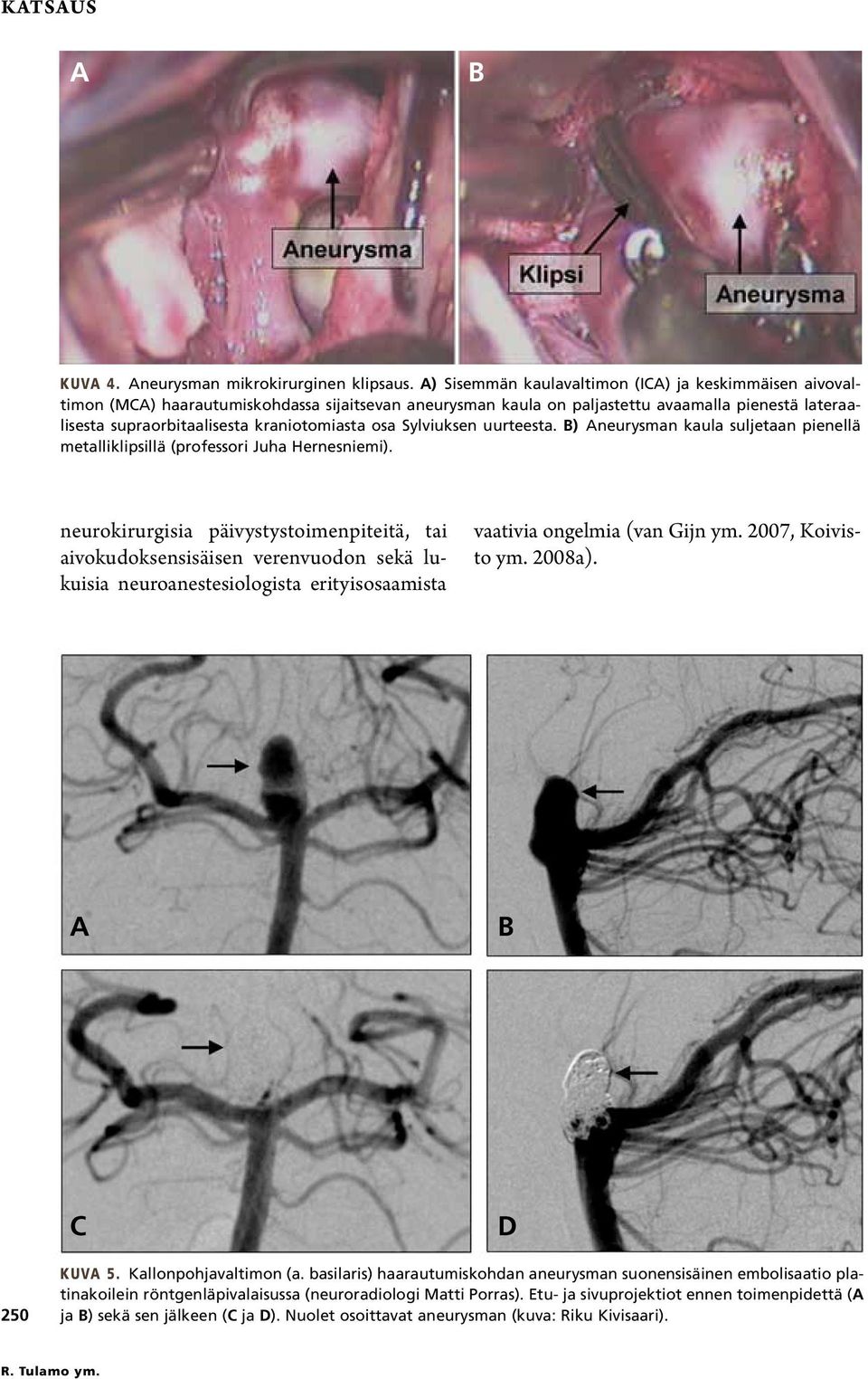 osa Sylviuksen uurteesta. B) Aneurysman kaula suljetaan pienellä metalliklipsillä (professori Juha Hernesniemi).