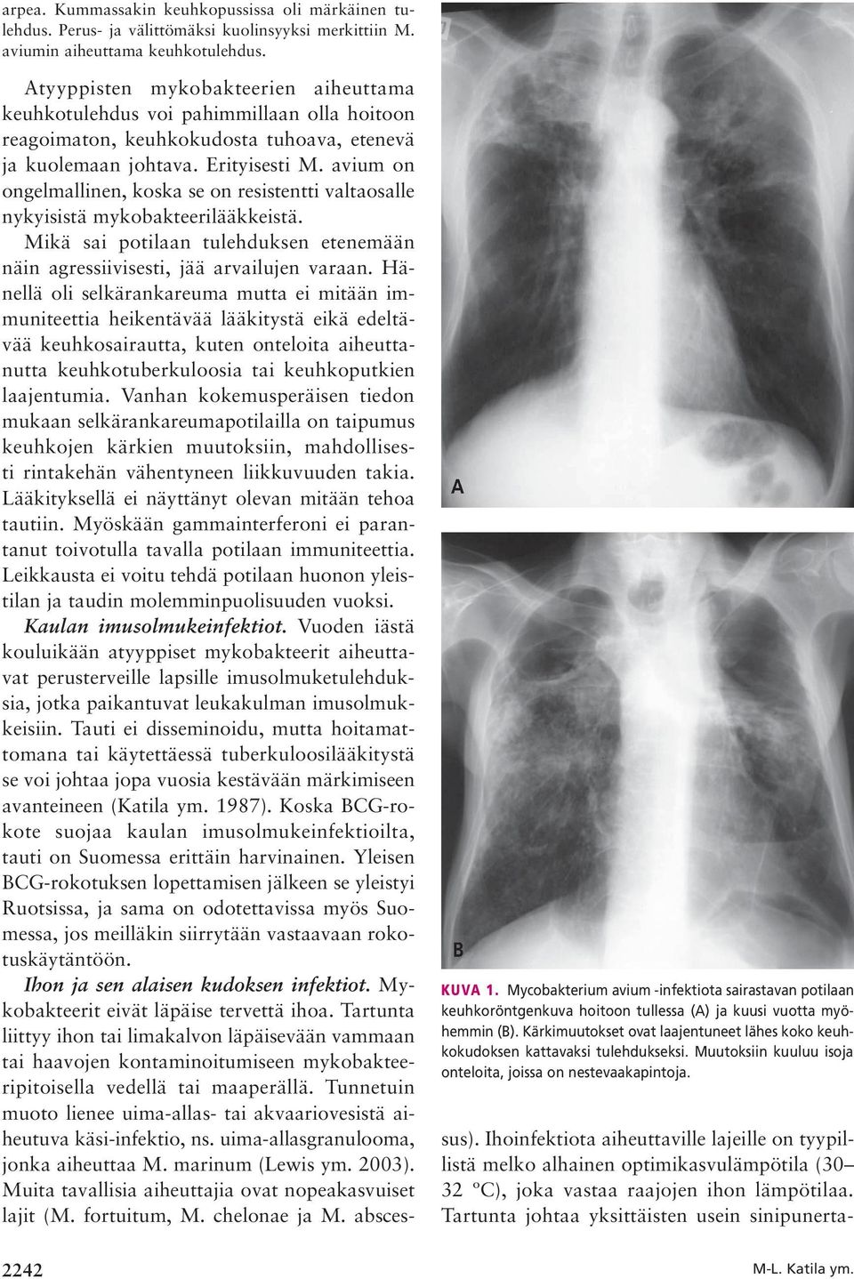 avium on ongelmallinen, koska se on resistentti valtaosalle nykyisistä mykobakteerilääkkeistä. Mikä sai potilaan tulehduksen etenemään näin agressiivisesti, jää arvailujen varaan.