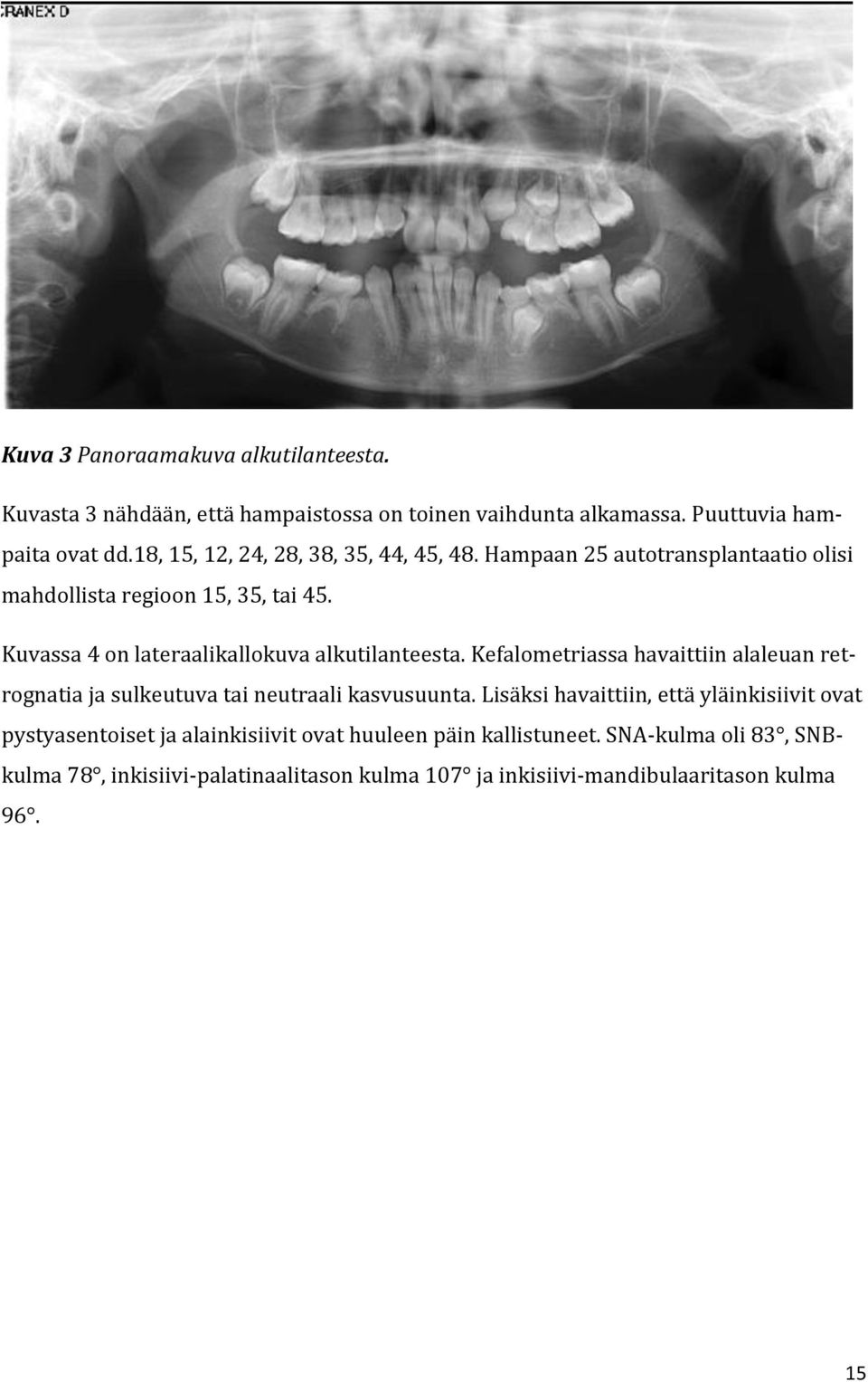 Kuvassa 4 on lateraalikallokuva alkutilanteesta. Kefalometriassa havaittiin alaleuan retrognatia ja sulkeutuva tai neutraali kasvusuunta.