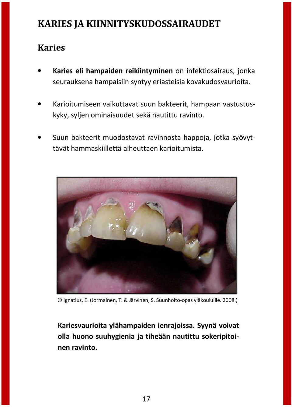 Suun bakteerit muodostavat ravinnosta happoja, jotka syövyttävät hammaskiillettä aiheuttaen karioitumista. Ignatius, E. (Jormainen, T.