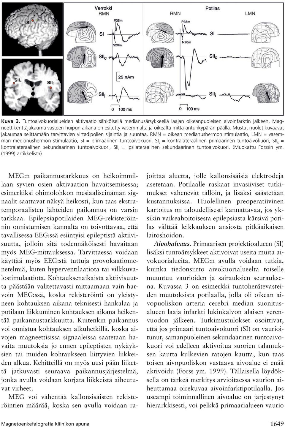 RMN = oikean medianushermon stimulaatio, LMN = vasemman medianushermon stimulaatio, SI = primaarinen tuntoaivokuori, SI c = kontralateraalinen primaarinen tuntoaivokuori, SII c = kontralateraalinen