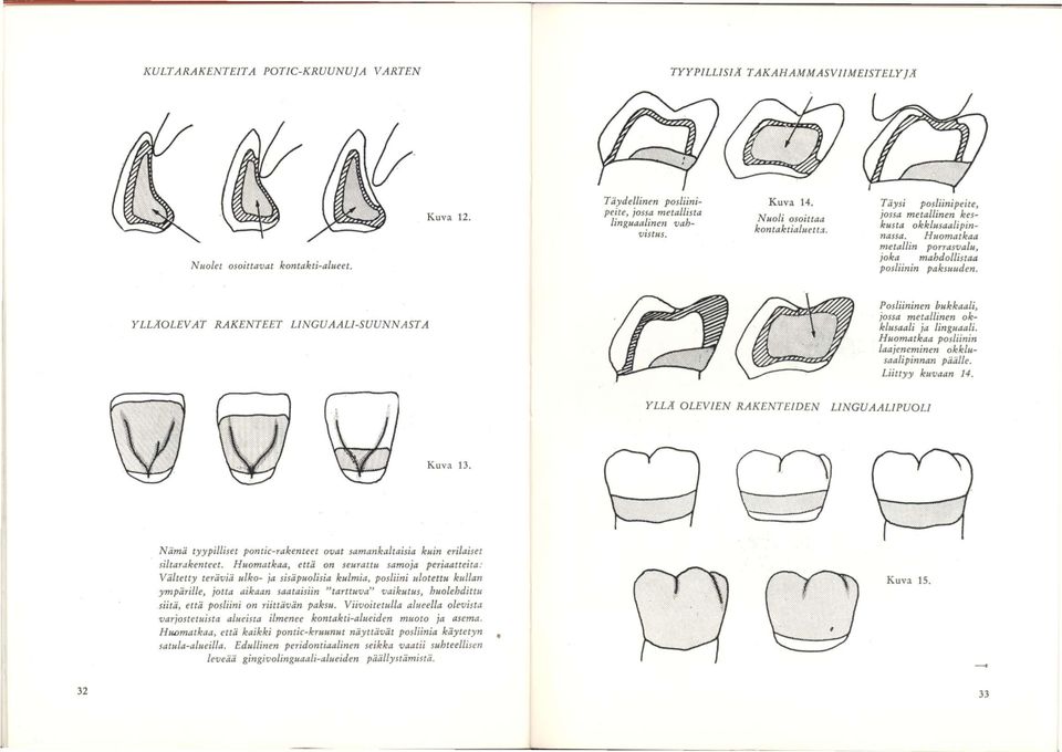YLLÄOLEVAT RAKENTEET LINGUAALI-SUUNNASTA Posliininen hukkaali, jossa metallinen okklusaali ja linguaali. Huomatkaa posliinin laajeneminen okklusaalipinnan päälle. Liittyy kuvaan 14.