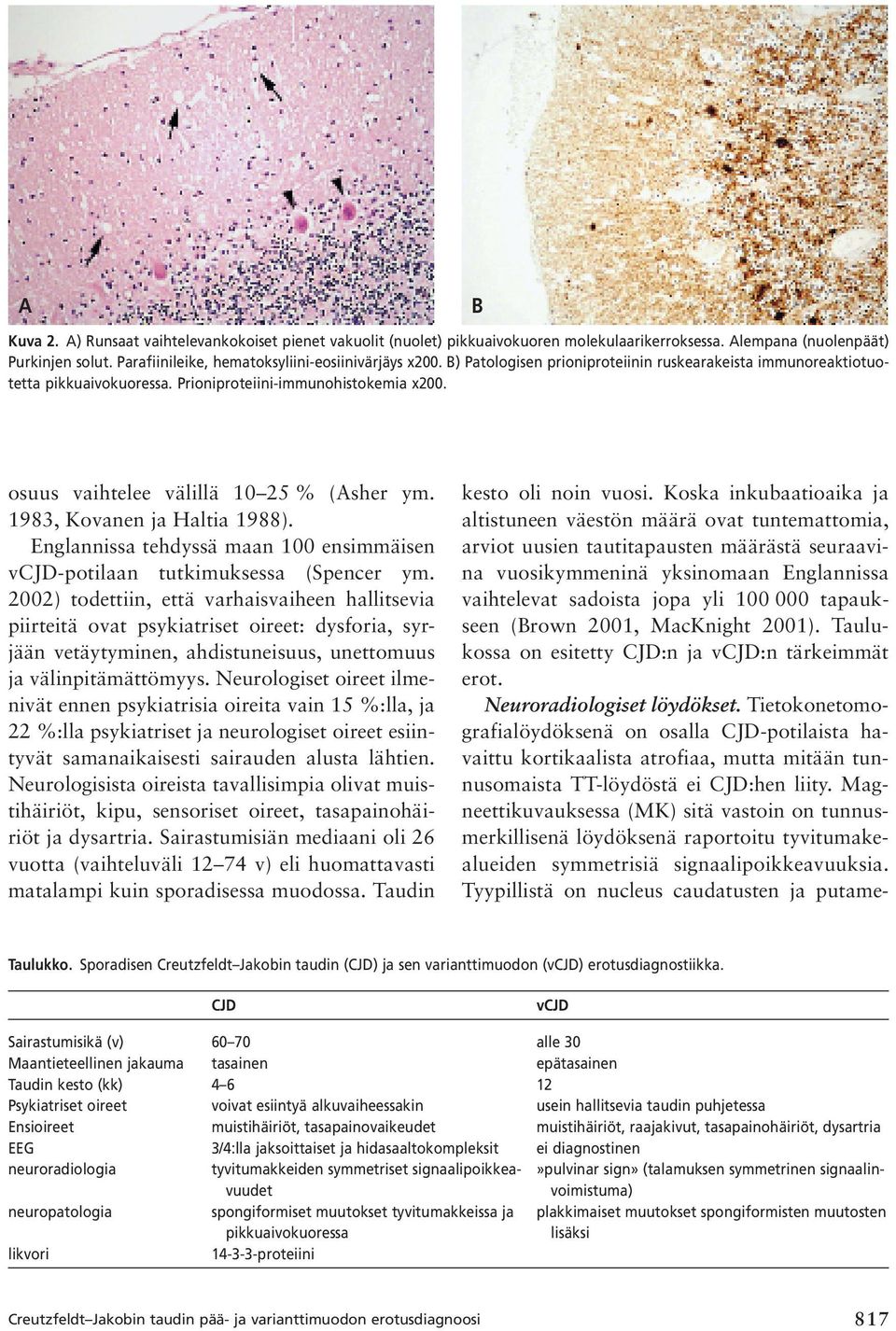 1983, Kovanen ja Haltia 1988). Englannissa tehdyssä maan 100 ensimmäisen vcjd-potilaan tutkimuksessa (Spencer ym.