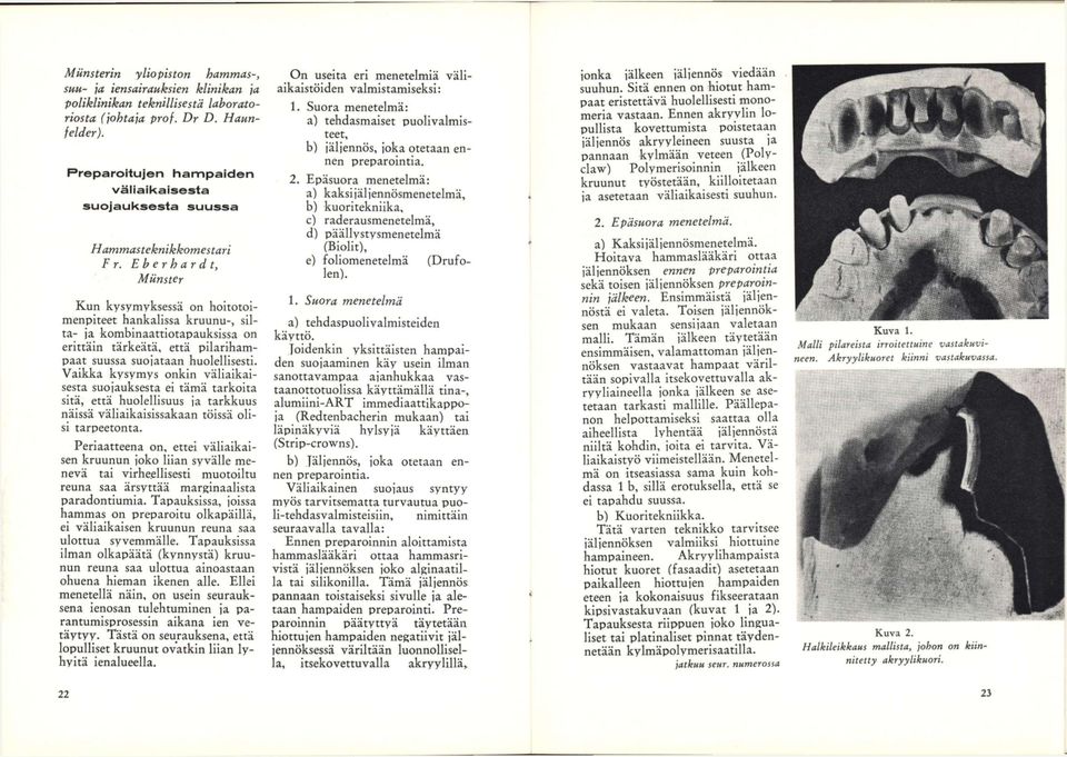 Eberhard t, Miinster Kun kysymyksessä on hoitotoimenpiteet hankalissa kruunu-, silta- ja kombinaattiotapauksissa on erittäin tärkeätä, että pilarihampaat suussa suojataan huolellisesti.