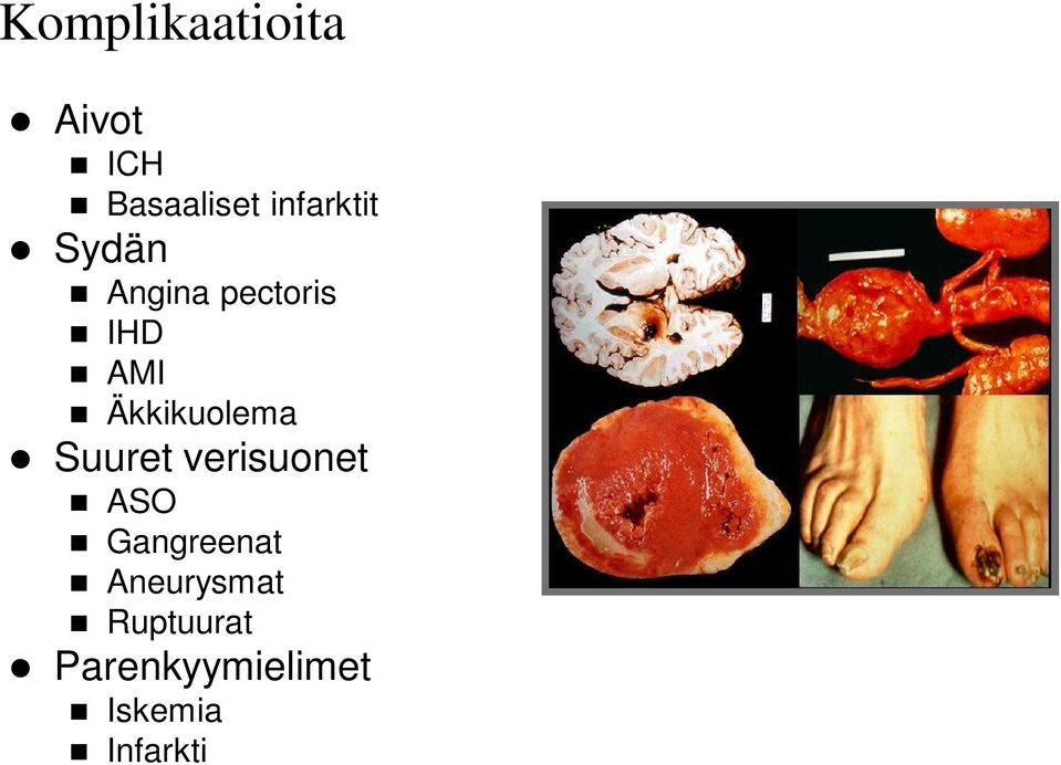 Äkkikuolema Suuret verisuonet ASO