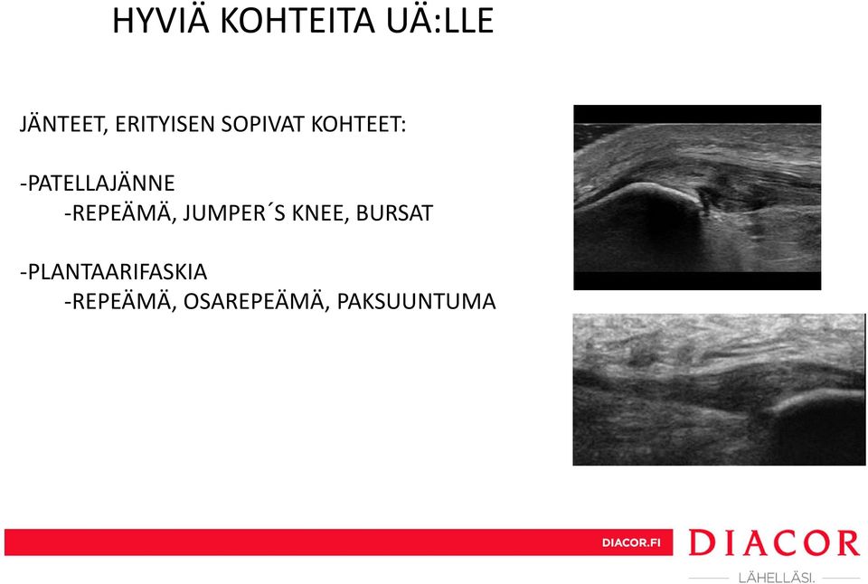 PATELLAJÄNNE REPEÄMÄ, JUMPER S KNEE,