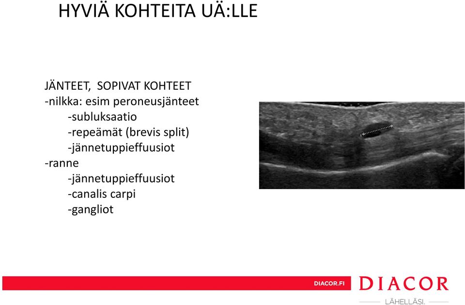 subluksaatio repeämät (brevis split)