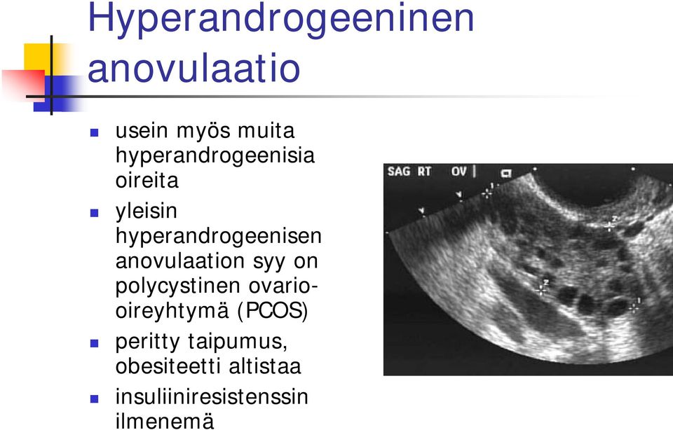 anovulaation syy on polycystinen ovariooireyhtymä (PCOS)