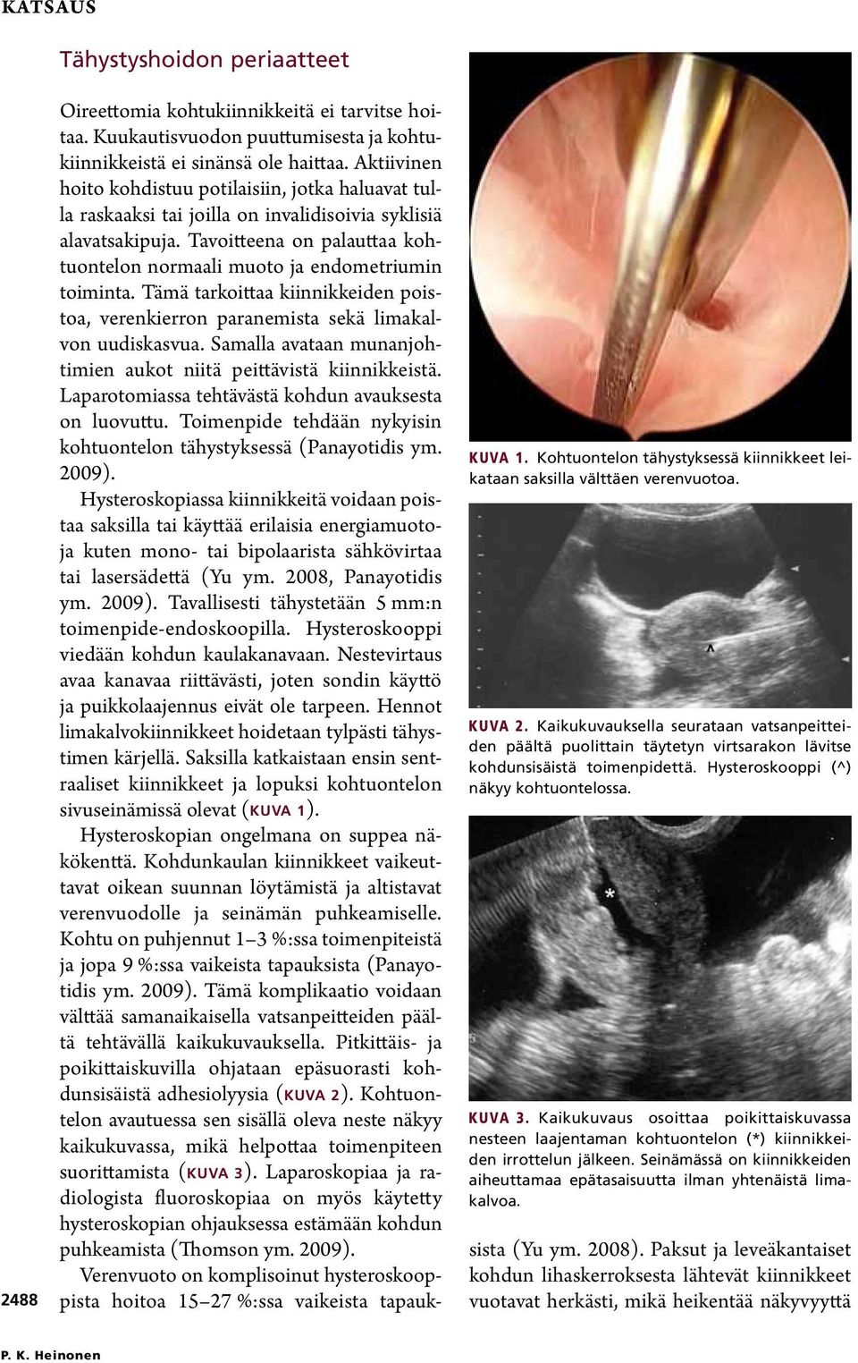 Kaikukuvaus osoittaa poikittaiskuvassa nesteen laajentaman kohtuontelon (*) kiinnikkeiden irrottelun jälkeen. Seinämässä on kiinnikkeiden aiheut tamaa epätasaisuutta ilman yhtenäistä limakalvoa.