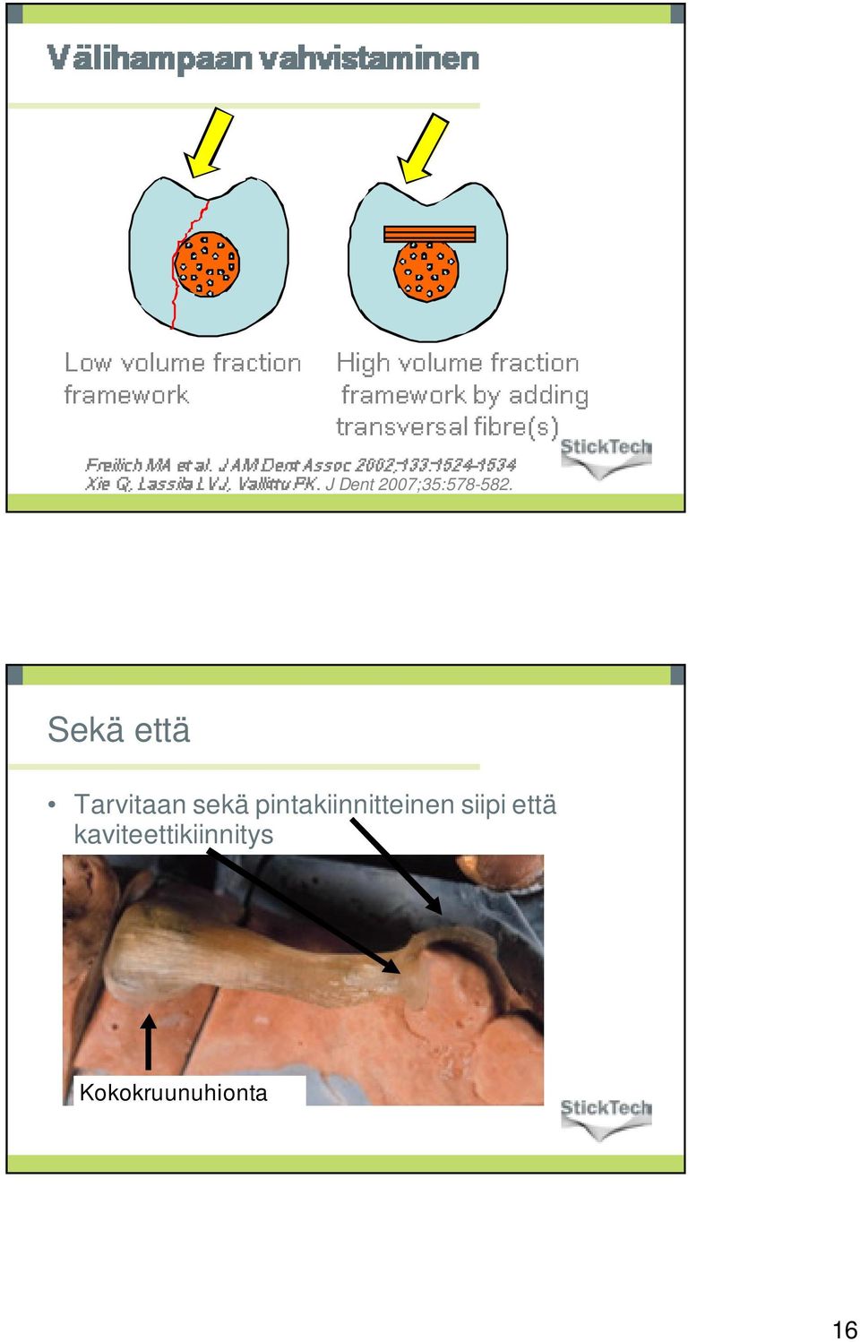 Assoc transversal framework 2002;133:1524-1534 by fibre(s) adding J Dent