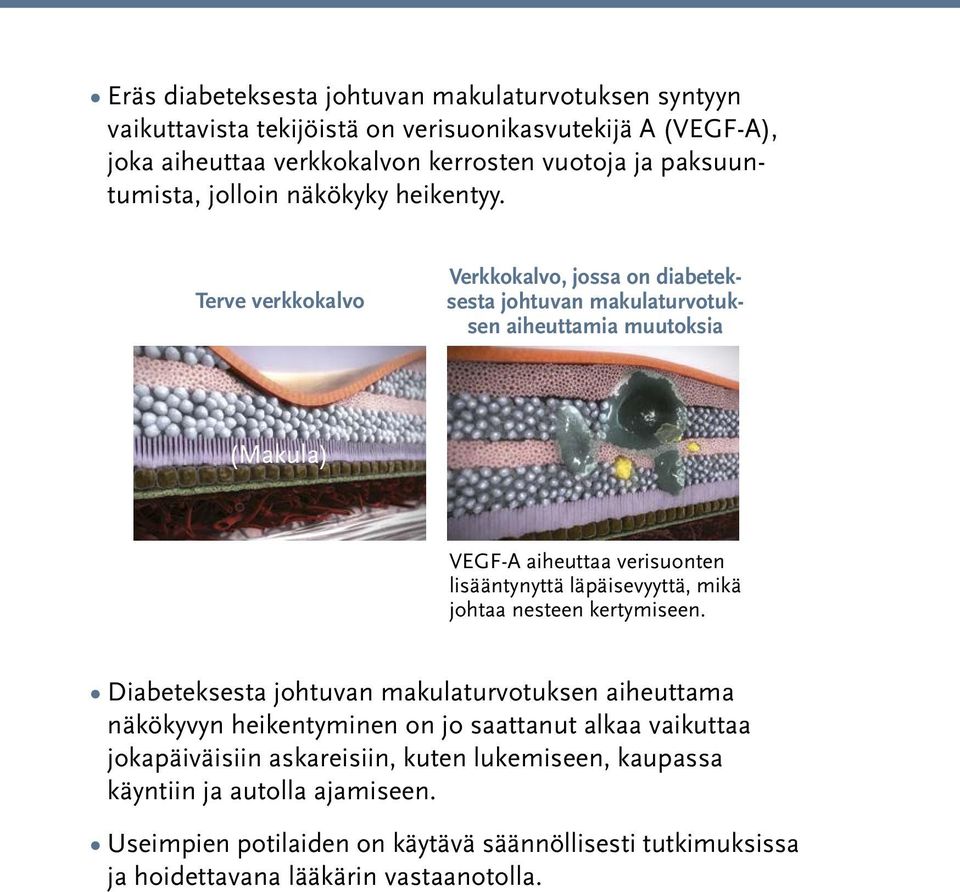 Terve verkkokalvo Verkkokalvo, jossa on diabeteksesta johtuvan makulaturvotuksen aiheuttamia muutoksia (Makula) VEGF-A aiheuttaa verisuonten lisääntynyttä läpäisevyyttä, mikä