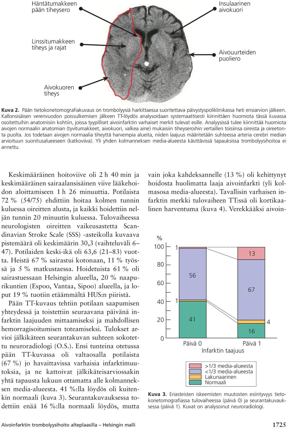 Kallonsisäisen verenvuodon poissulkemisen jälkeen TT-löydös analysoidaan systemaattisesti kiinnittäen huomiota tässä kuvassa osoitettuihin anatomisiin kohtiin, joissa tyypilliset aivoinfarktin