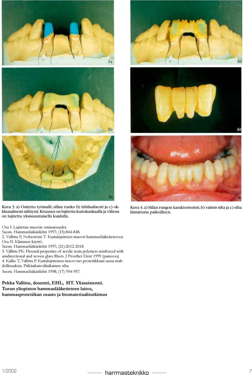 Kuitulujitteiset muovit hammaslääketieteessä. Osa II: Kliininen käyttö. Suom. Hammaslääkärilehti 1997; (21):2012-2018. 3. Vallittu PK.
