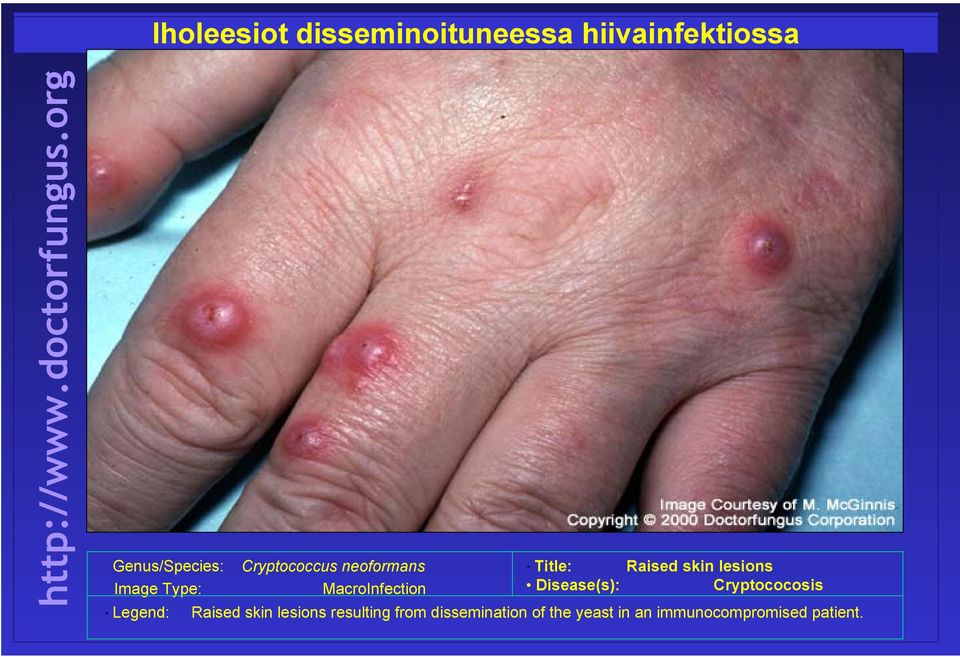 Image Type: MacroInfection Disease(s): Cryptococosis Legend: Raised skin