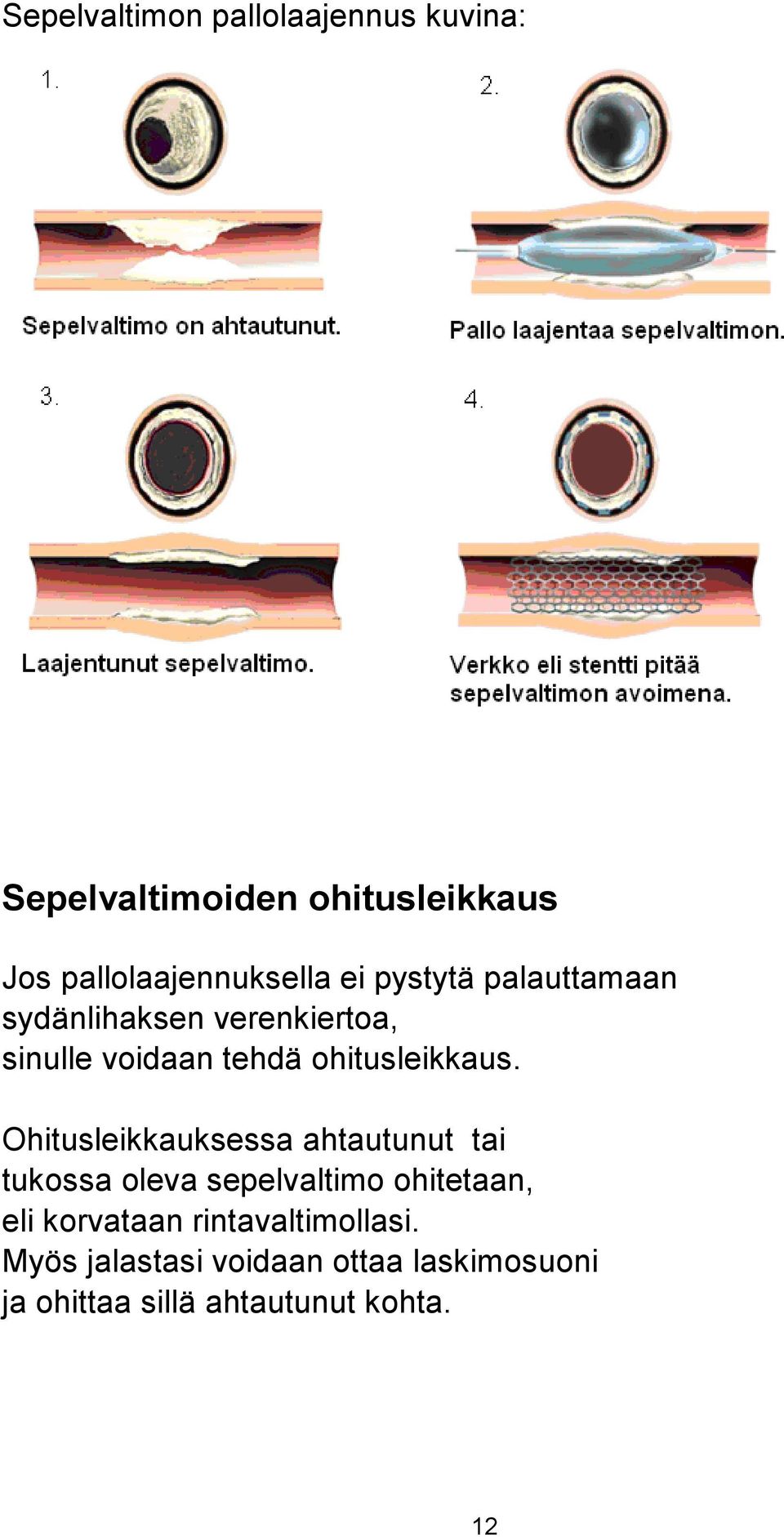 tehdä ohitusleikkaus.