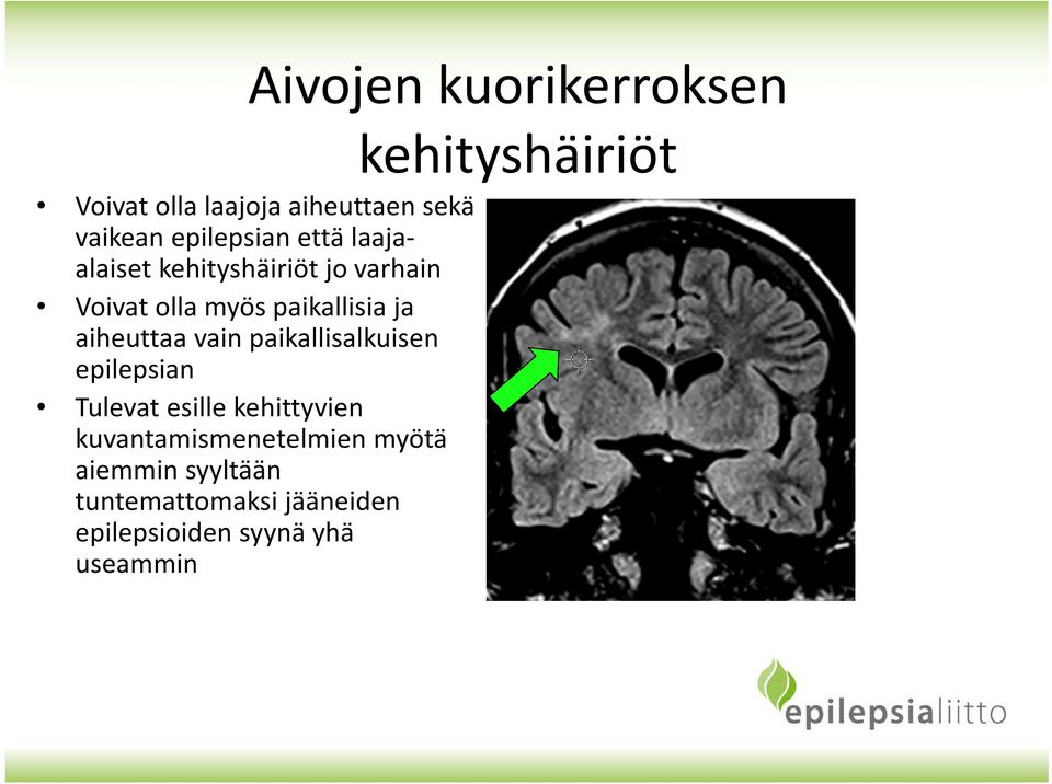 ja aiheuttaa vain paikallisalkuisen epilepsian Tulevat esille kehittyvien