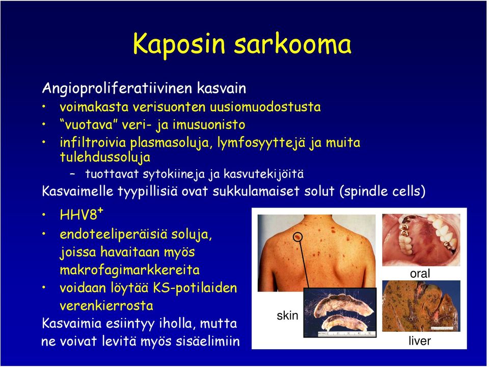 tyypillisiä ovat sukkulamaiset solut (spindle cells) HHV8 + endoteeliperäisiä soluja, joissa havaitaan myös