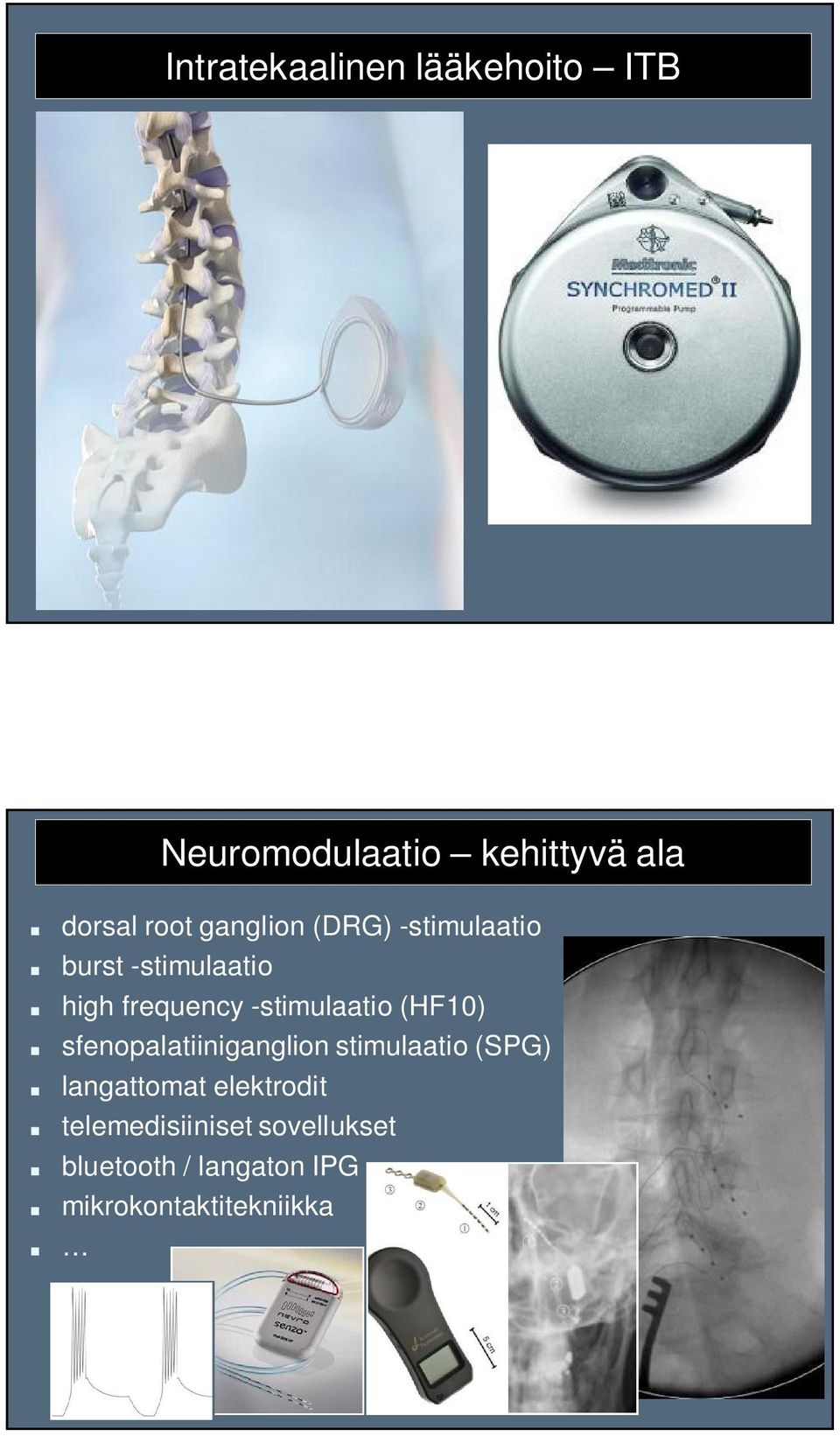 -stimulaatio (HF10) sfenopalatiiniganglion stimulaatio (SPG) langattomat