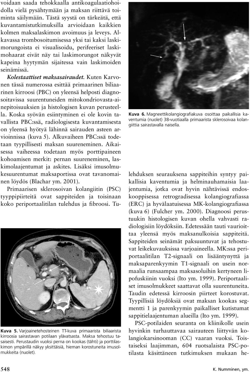 Magneettikolangiografiakuva osoittaa paikallisia kaventumia (nuolet) 38-vuotiaalla primaarista sklerosoivaa kolangiittia sairastavalla naisella.