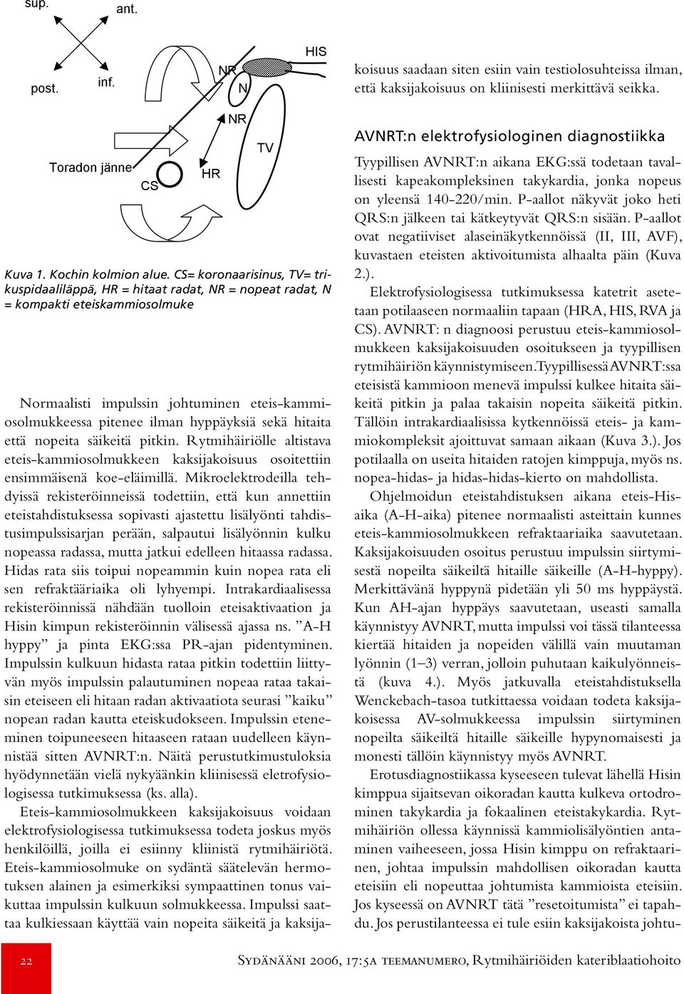 CS= koronaarisinus, TV= trikuspidaaliläppä, HR = hitaat radat, NR = nopeat radat, N = kompakti eteiskammiosolmuke Normaalisti impulssin johtuminen eteis-kammiosolmukkeessa pitenee ilman hyppäyksiä