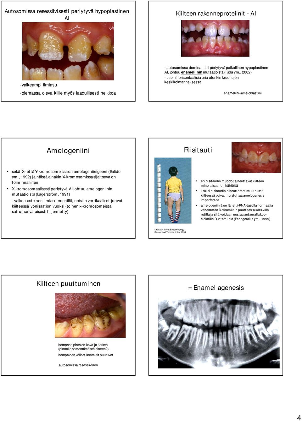 , 2002) - usein horisontaalisia uria etenkin kruunujen keskikolmanneksessa enameliini=ameloblastiini Amelogeniini Riisitauti sekä X- että Y-kromosomeissa on amelogeniinigeeni (Salido ym.