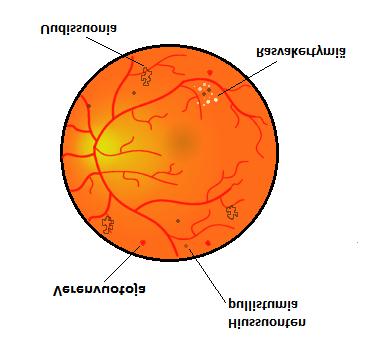 44 2 (2) Proliferatiivinen retinopatia Lukijalle Jos retinopatia etenee, hiussuonten tukkeutuminen johtaa verkkokalvon hapenpuutteeseen, jolloin elimistö muodostaa uudissuonia korjatakseen tilanteen.