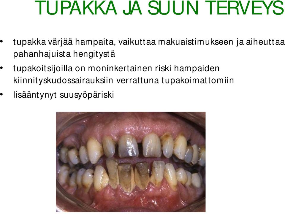 tupakoitsijoilla on moninkertainen riski hampaiden