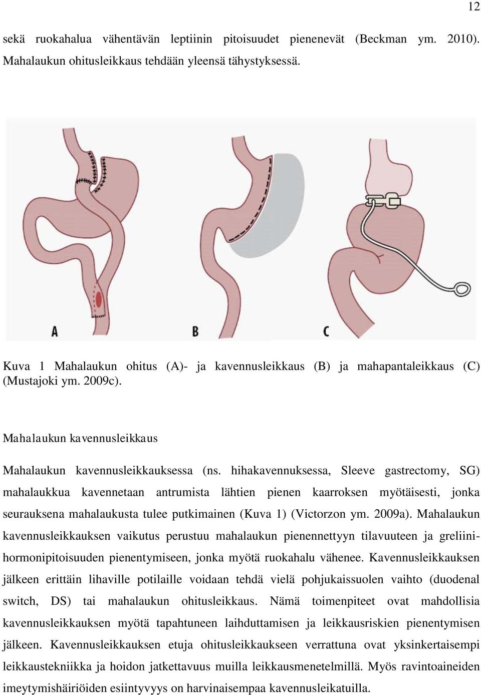 hihakavennuksessa, Sleeve gastrectomy, SG) mahalaukkua kavennetaan antrumista lähtien pienen kaarroksen myötäisesti, jonka seurauksena mahalaukusta tulee putkimainen (Kuva 1) (Victorzon ym. 2009a).