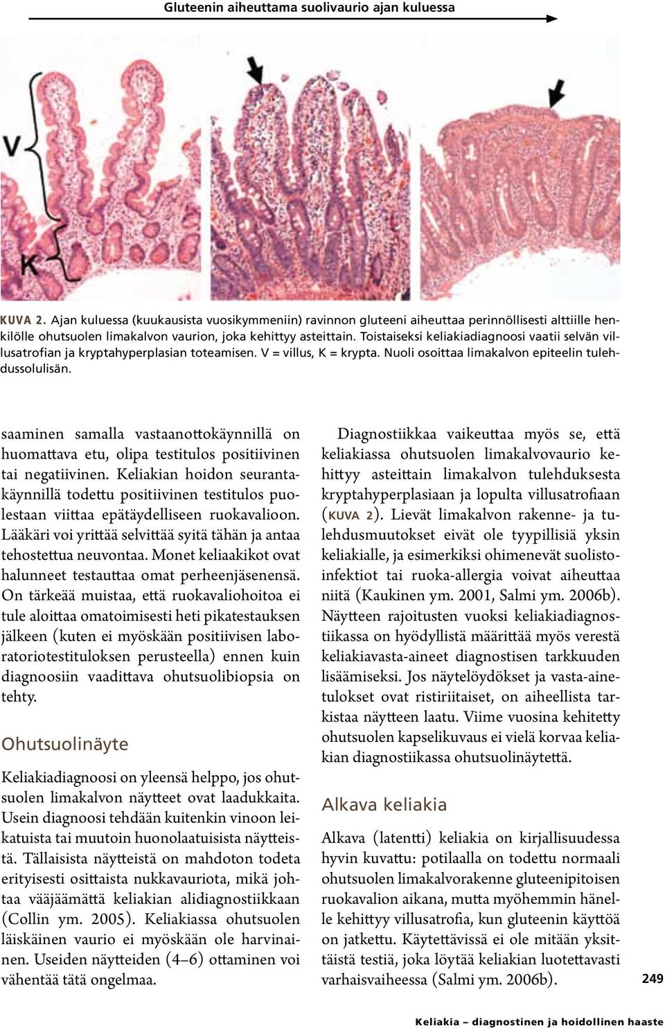 Toistaiseksi keliakiadiagnoosi vaatii selvän villusatrofian ja kryptahyperplasian toteamisen. V = villus, K = krypta. Nuoli osoittaa limakalvon epiteelin tulehdussolulisän.