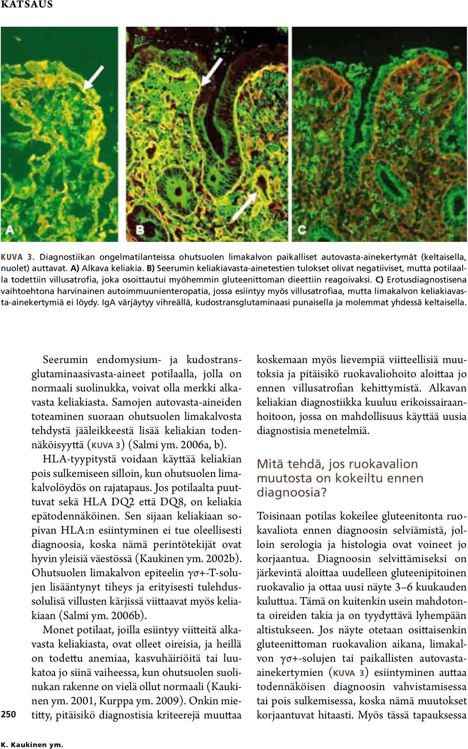 C) Erotusdiagnostisena vaihtoehtona harvinainen autoimmuunienteropatia, jossa esiintyy myös villusatrofiaa, mutta limakalvon keliakiavasta-ainekertymiä ei löydy.