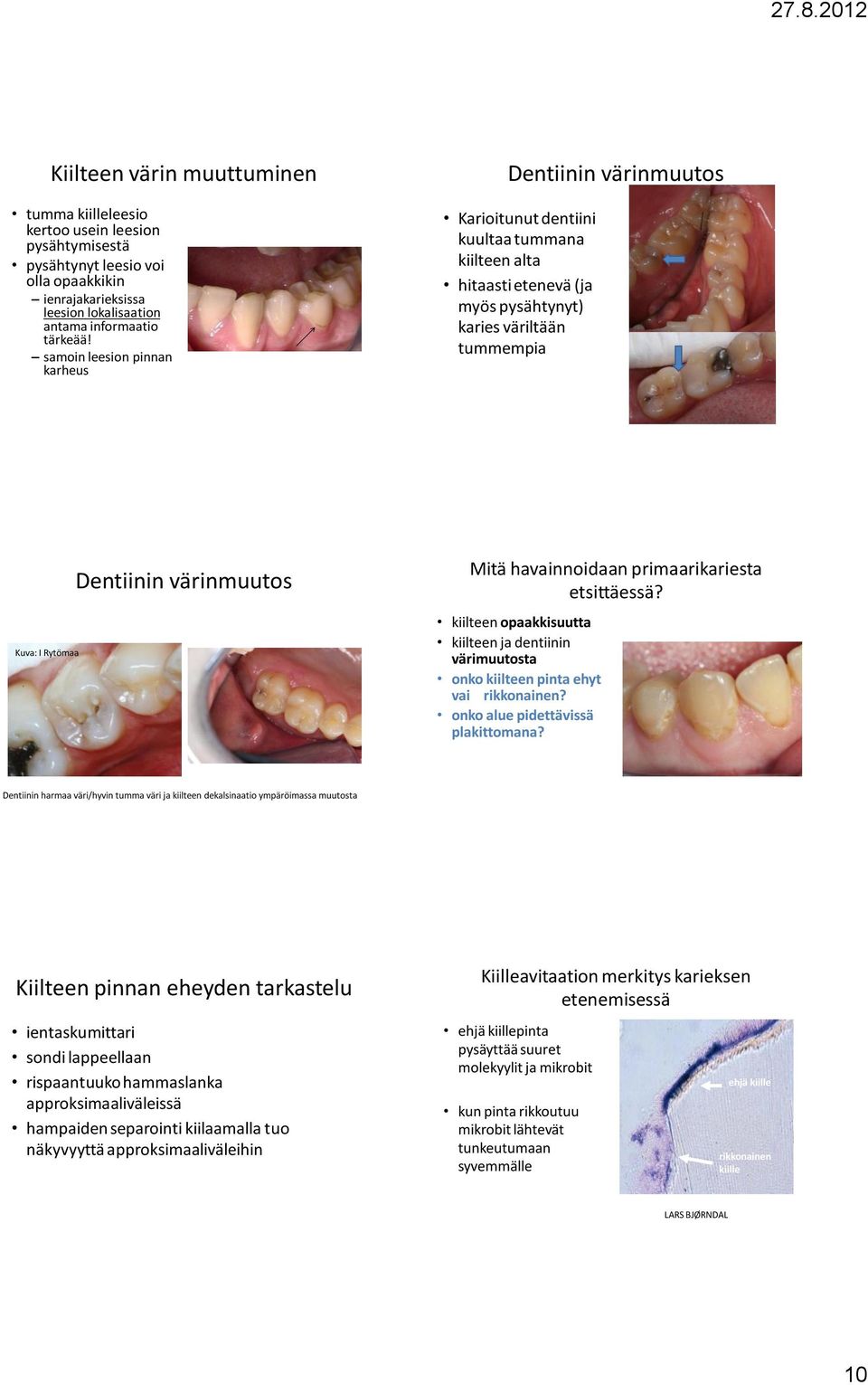 värinmuutos Mitä havainnoidaan primaarikariesta etsittäessä? kiilteen opaakkisuutta kiilteen ja dentiinin värimuutosta onko kiilteen pinta ehyt vai rikkonainen? onko alue pidettävissä plakittomana?