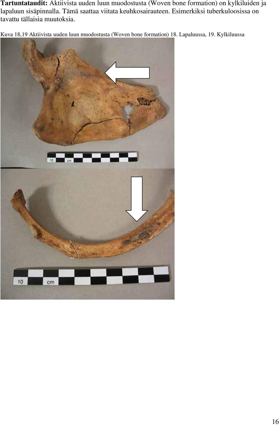 Esimerkiksi tuberkuloosissa on tavattu tällaisia muutoksia.