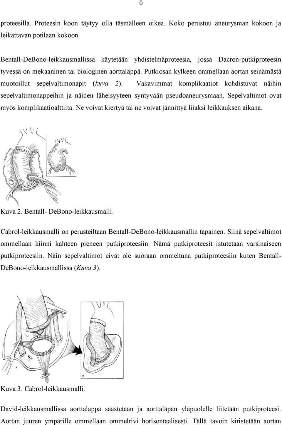 Putkiosan kylkeen ommellaan aortan seinämästä muotoillut sepelvaltimonapit (kuva 2).