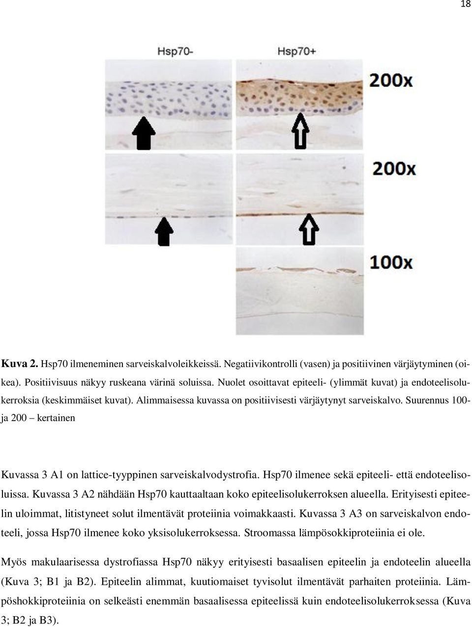 Suurennus 100- ja 200 kertainen Kuvassa 3 A1 on lattice-tyyppinen sarveiskalvodystrofia. Hsp70 ilmenee sekä epiteeli- että endoteelisoluissa.