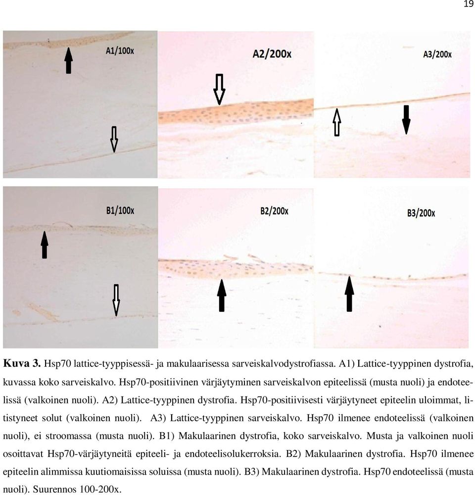 Hsp70-positiivisesti värjäytyneet epiteelin uloimmat, litistyneet solut (valkoinen nuoli). A3) Lattice-tyyppinen sarveiskalvo.