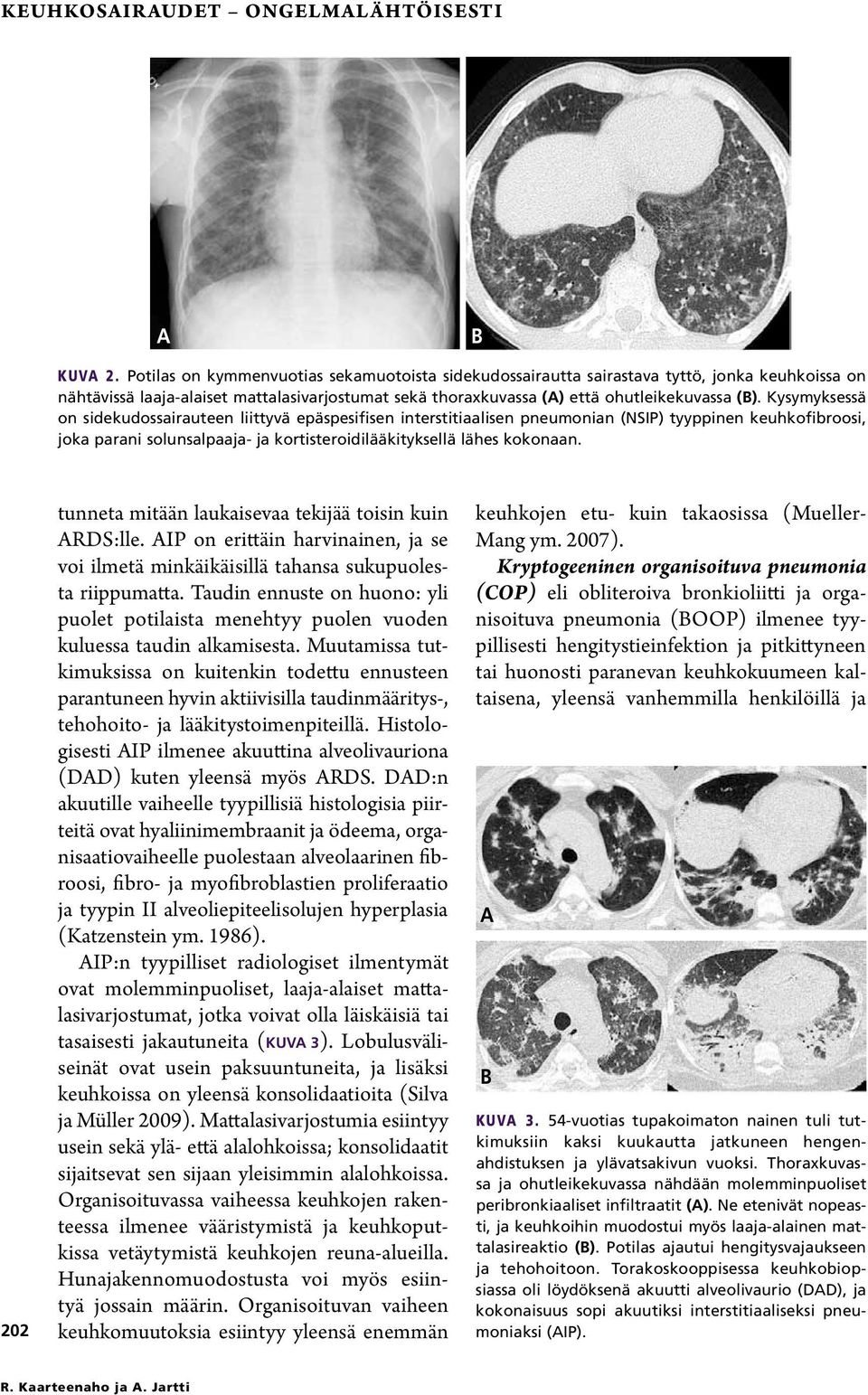 Kysymyksessä on sidekudossairauteen liittyvä epäspesifisen interstitiaalisen pneumonian (NSIP) tyyppinen keuhkofibroosi, joka parani solunsalpaaja- ja kortisteroidilääkityksellä lähes kokonaan.