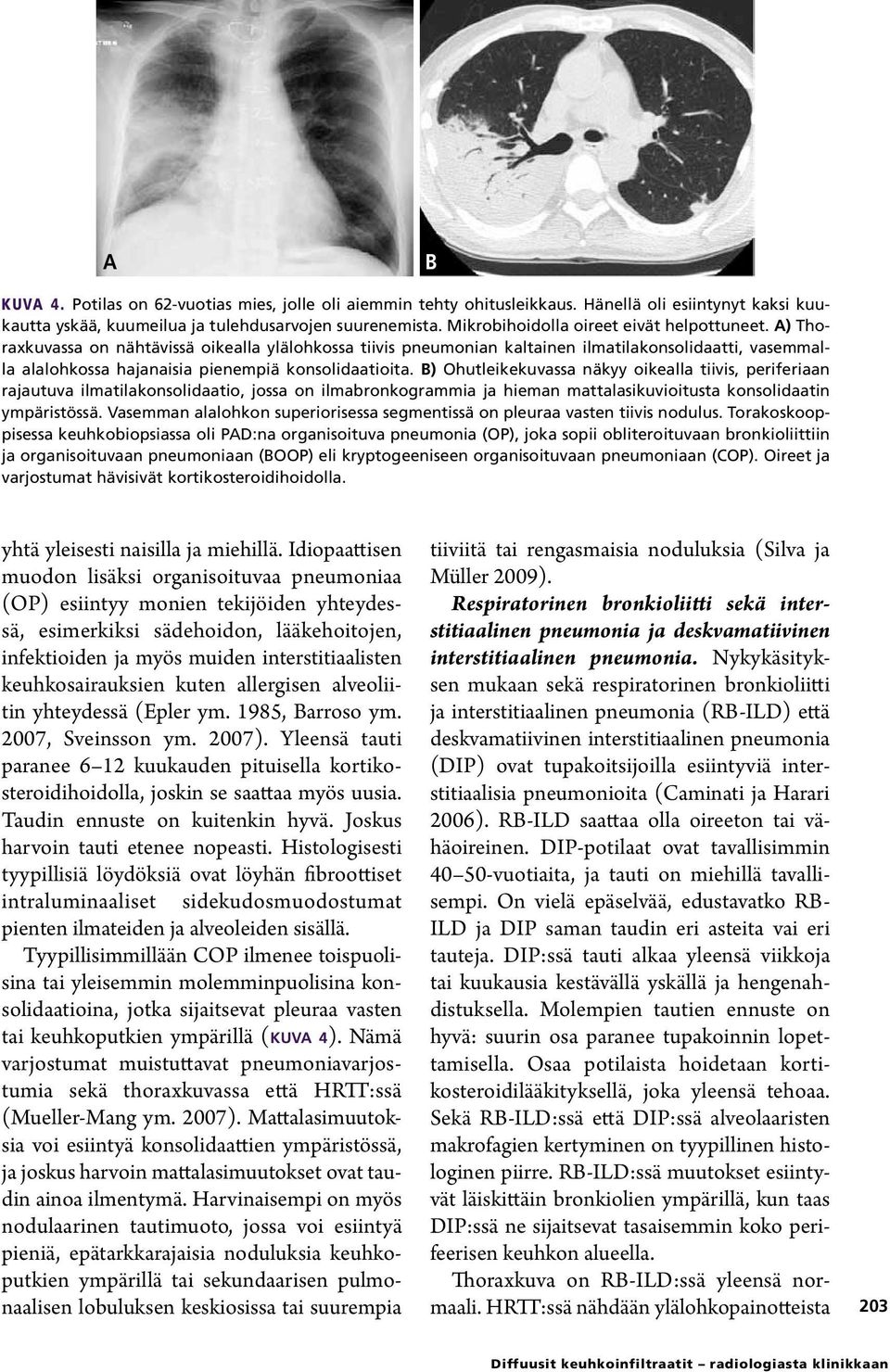 A) Thoraxkuvassa on nähtävissä oikealla ylälohkossa tiivis pneumonian kaltainen ilmatilakonsolidaatti, vasemmalla alalohkossa hajanaisia pienempiä konsolidaatioita.