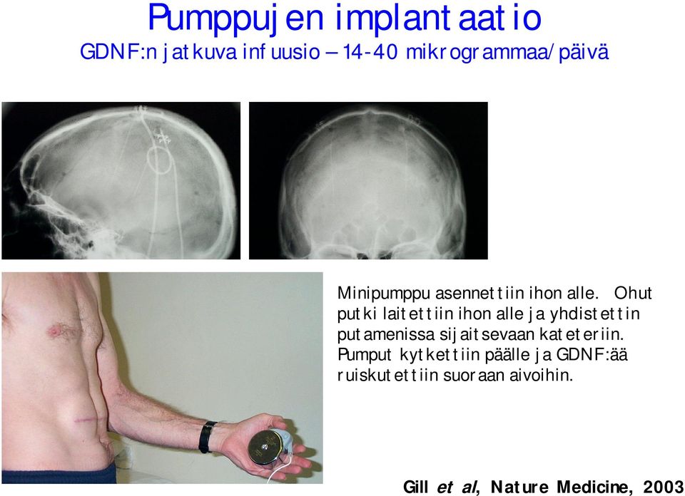 Ohut putki laitettiin ihon alle ja yhdistettin putamenissa sijaitsevaan