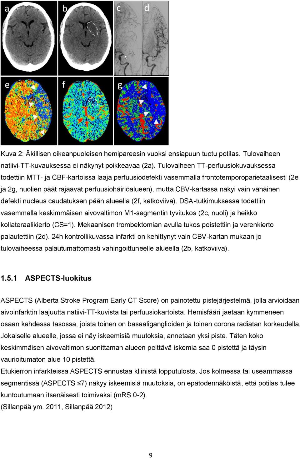 CBV-kartassa näkyi vain vähäinen defekti nucleus caudatuksen pään alueella (2f, katkoviiva).