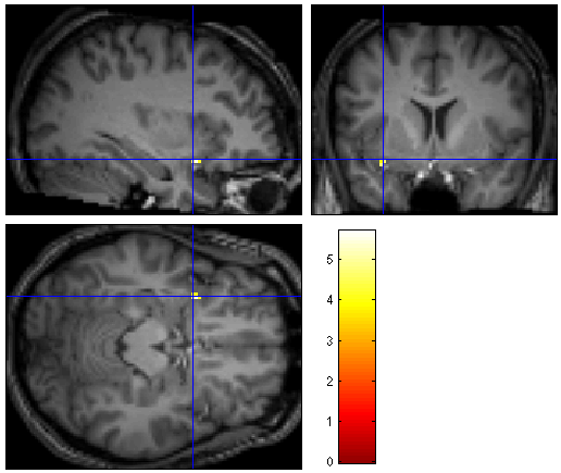 44 Kuva 5. Gyrus frontalis medius (vasen)-aktivaatioklusteri vertailusta 4. (ei-tunnesyöjät>tunnesyöjät) (MNI -44 40 24, T=5,61, p< 0.