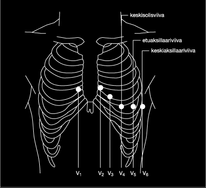 22 selkeä virhelähde. Jo 2 2,5 cm poikkeavuus elektrodien sijoittelussa voi aiheuttaa kliinisesti merkittäviä muutoksia EKG:n tulkinnassa. (McCann ym. 2007, 443; Riski 2004, 49 53; Kligfield ym.