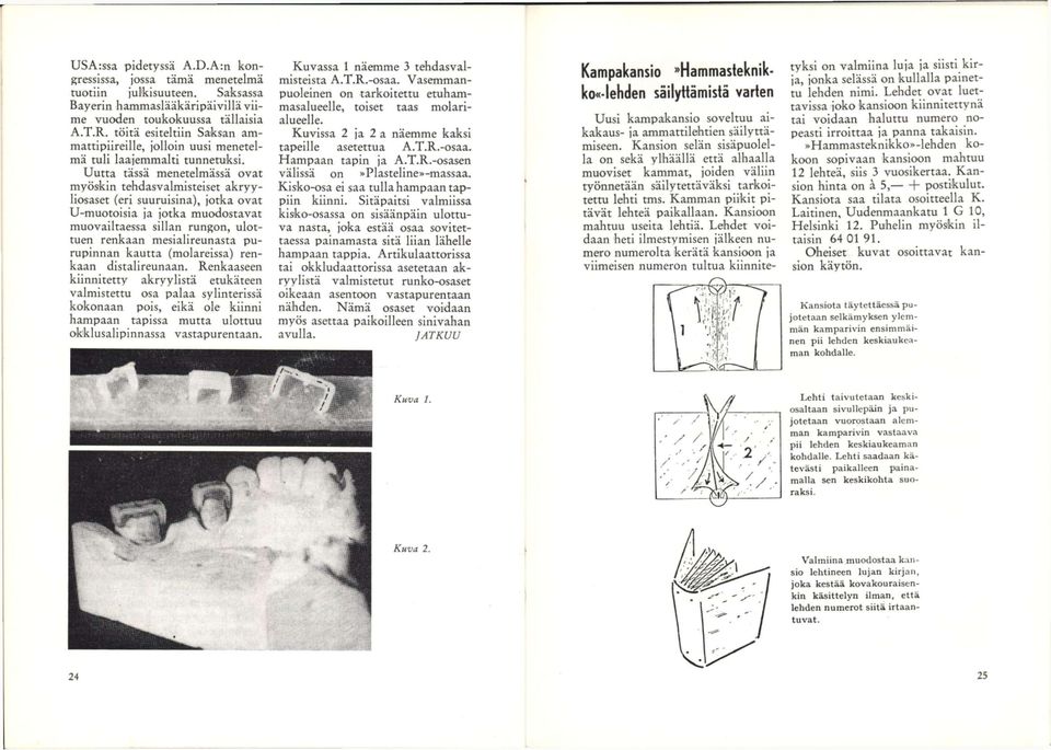 Uutta tässä menetelmässä ovat myöskin tehdasvalmisteiset akryyliosaset (eri suuruisina), jotka ovat U-muotoisia ja jotka muodostavat muovailtaessa sillan rungon, ulottuen renkaan mesialireunasta