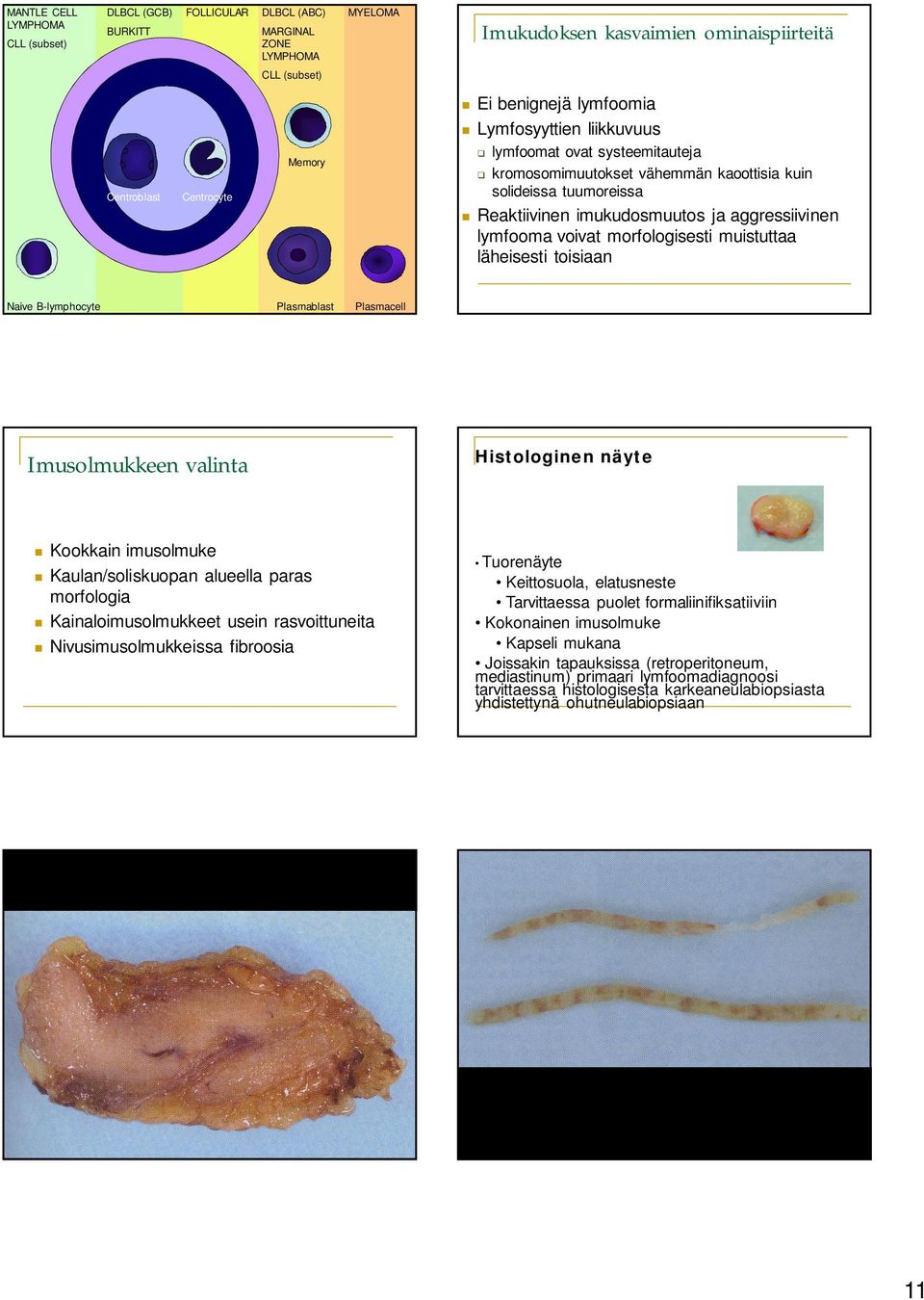 voivat morfologisesti muistuttaa läheisesti toisiaan Naive B-lymphocyte Plasmablast Plasmacell Imusolmukkeen valinta Histologinen näyte Kookkain imusolmuke Kaulan/soliskuopan alueella paras