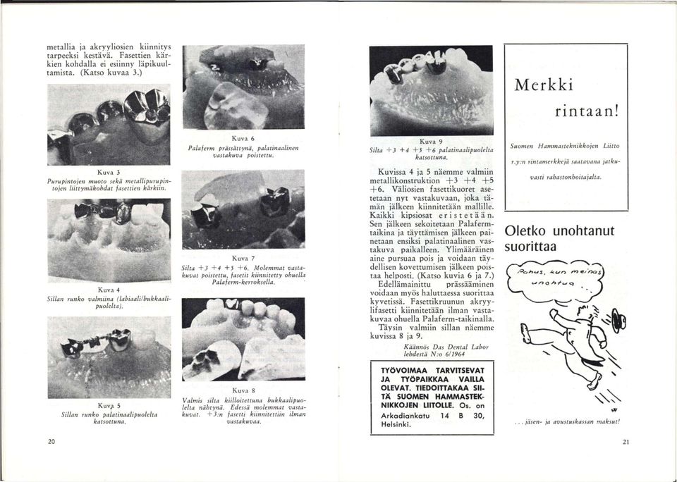 Kuva 4 Sillan runko valmiina (labiaali/hukkaalipuolelta). Kuva 7 Silta +3 +4 +3 +6. Molemmat vastakuvat poistettu, fasetit kiinnitetty ohuella Palaferm-kerroksella.