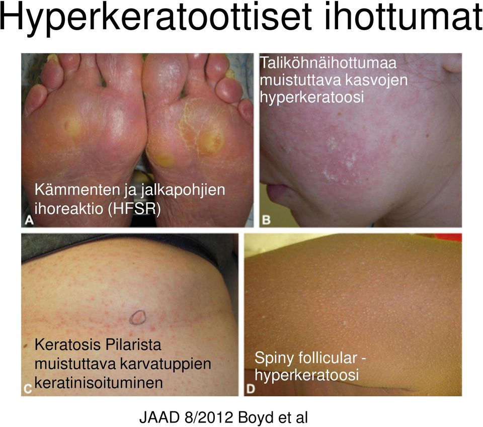 (HFSR) Keratosis Pilarista muistuttava karvatuppien