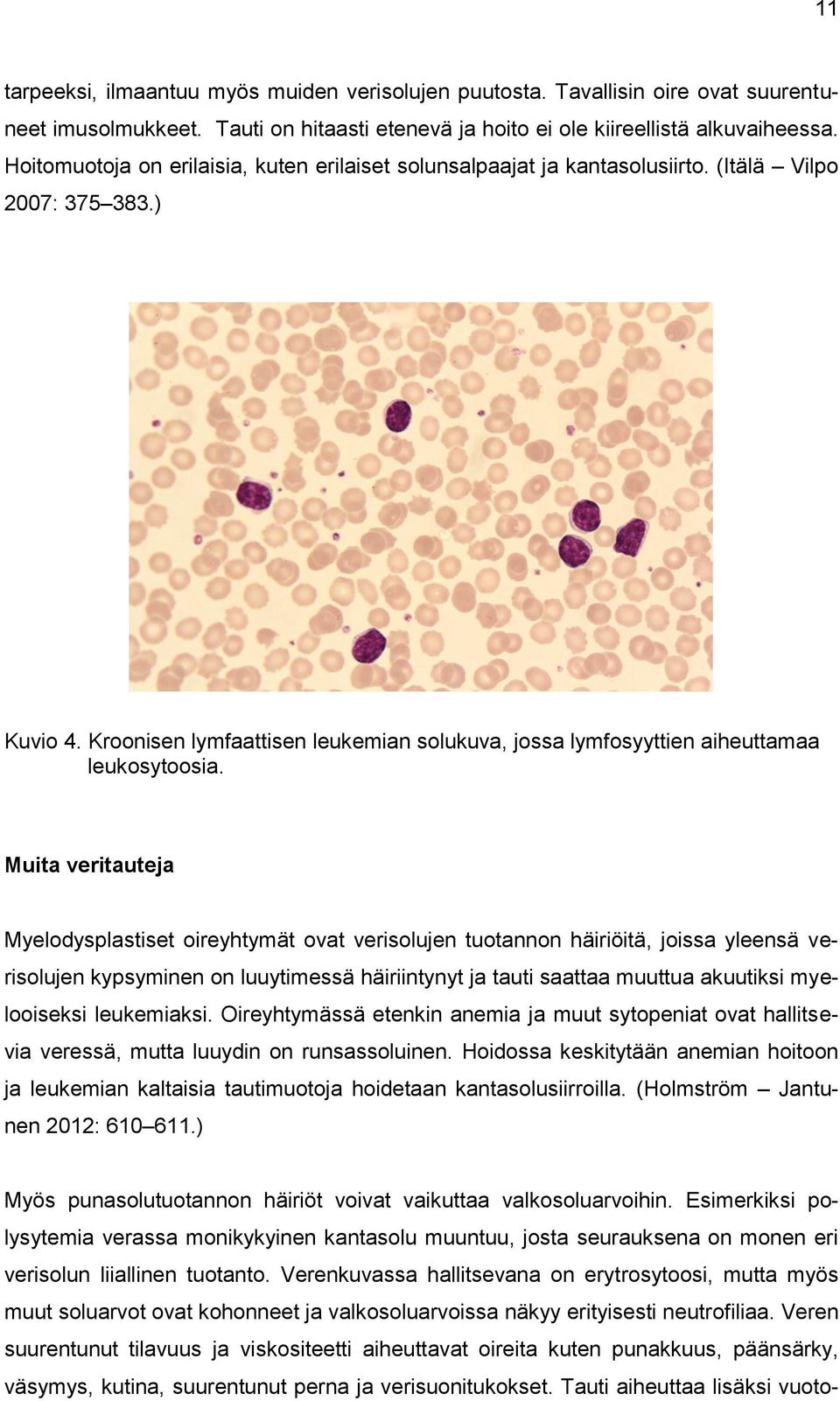 Kroonisen lymfaattisen leukemian solukuva, jossa lymfosyyttien aiheuttamaa leukosytoosia.