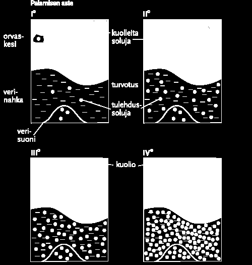 23 orvaskeden okasoluista on jo kuollut. (Hannuksela 2006: 30.) UV-A säteily saa aikaan kaksivaiheisen näkyvän palamisen.